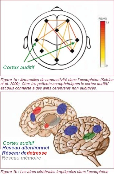 Les acouphènes permanents - AUDITION CONSEIL France