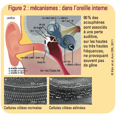 Acouphènes – identifier et combattre ces bruits parasites